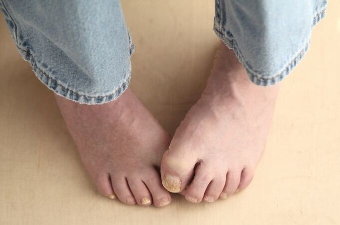 Πόδια με νύχια που έχουν προσβληθεί από μύκητες